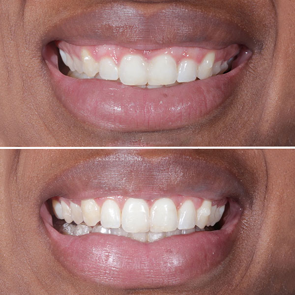 شرایط افزایش طول تاج دندان