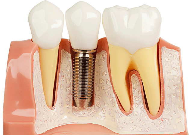 پایه و ساختار ایمپلنت دندان چیست