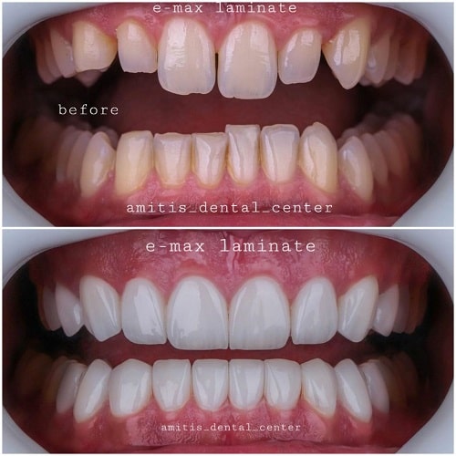 نمونه درمان لمینت دندان توسط دندانپزشکی آمیتیس