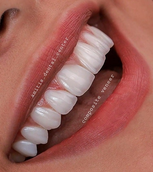 نمونه درمان لمینت دندان دندانپزشکی آمیتیس