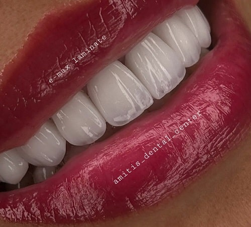 نمونه عکس لمینت دندان در دندانپزشکی آمیتیس