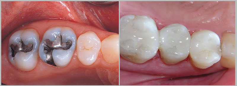 تفاوت ترمیم آمالگام با کامپوزیت در پر کردن دندان