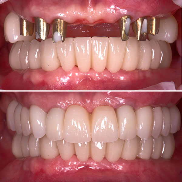 نمونه عکس ایمپلنت دندان قبل و بعد