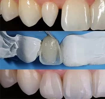 کامپوزیت ونیر دندان چیست