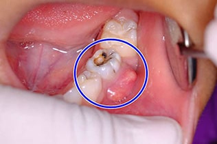 عفونت دندان بعد از عصب کشی