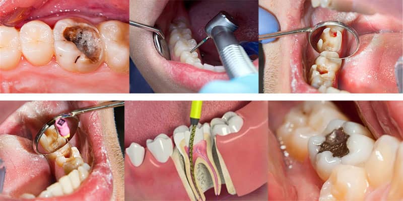 تفاوت ریشه دندان و عصب کشی