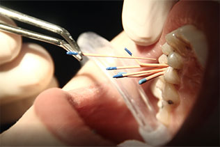 تفاوت درمان ریشه دندان و عصب کشی
