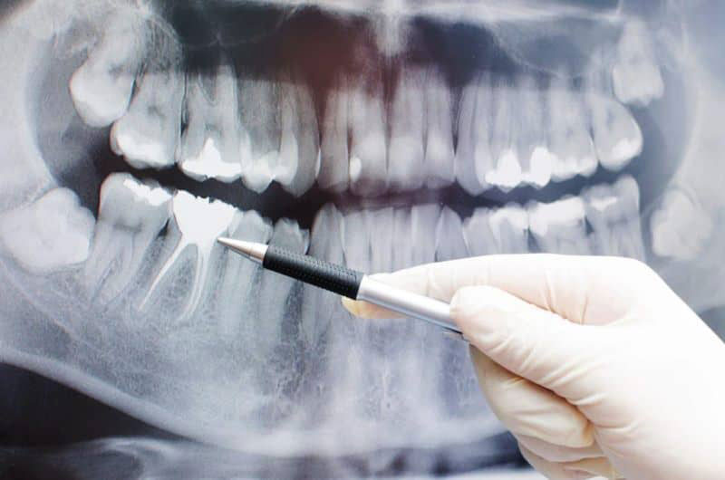 روش درمان ریشه دندان