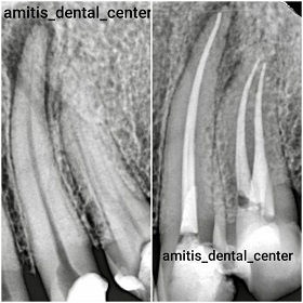 قبل و بعد درمان ریشه دندان لترال و کانین 