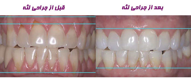 مراحل جراحی لثه