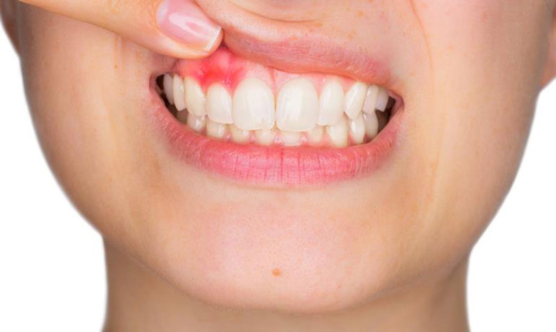 التهاب دندان بعد از عصب کشی 