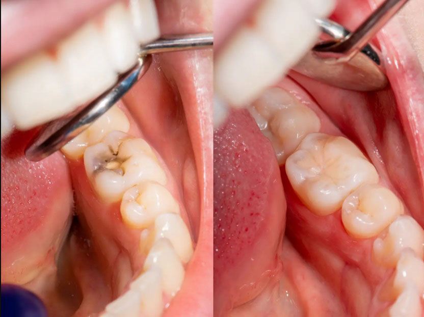 نکات مهم جهت کاهش درد دندان بعد از عصب کشی
