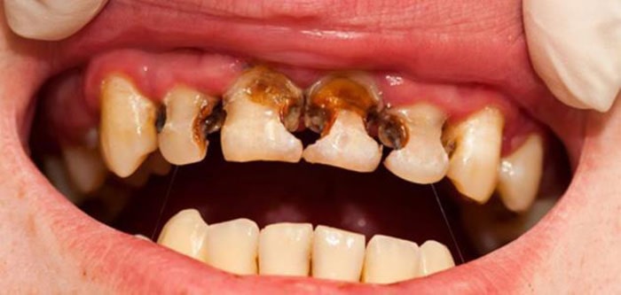 پوسیدگی دندان و یا عفونت شدید