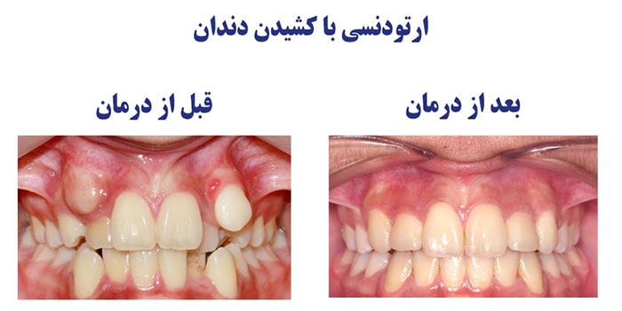 کشیدن دندان برای ارتودنسی
