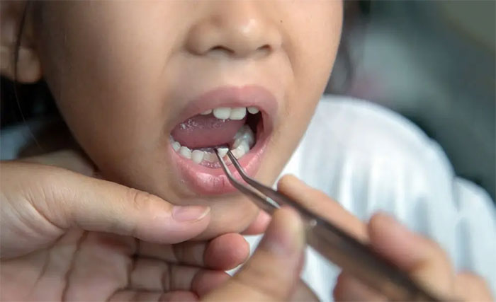 کشیدن دندان شیری
