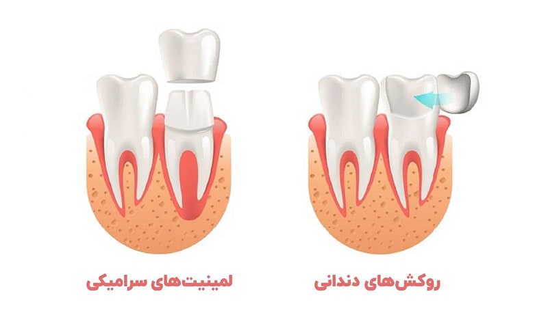 برای دندان عصب کشی شده روکش بهتر است یا لمینت