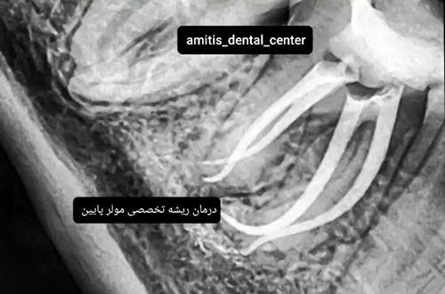 درمان ریشه دندان