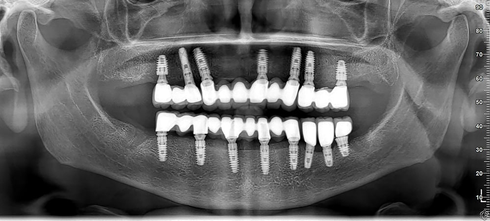 ایمپلنت کامل دندان چیست