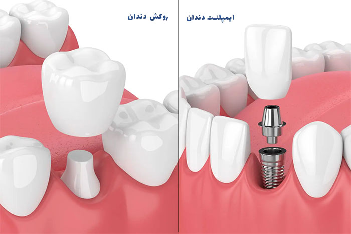 تفاوت های روکش دندان و ایمپلنت دندان 