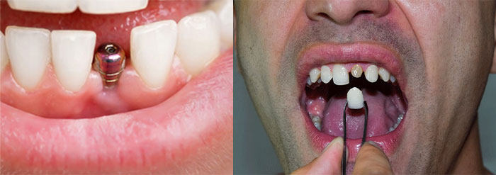 مقایسه هزینه ایمپلنت و روکش دندان