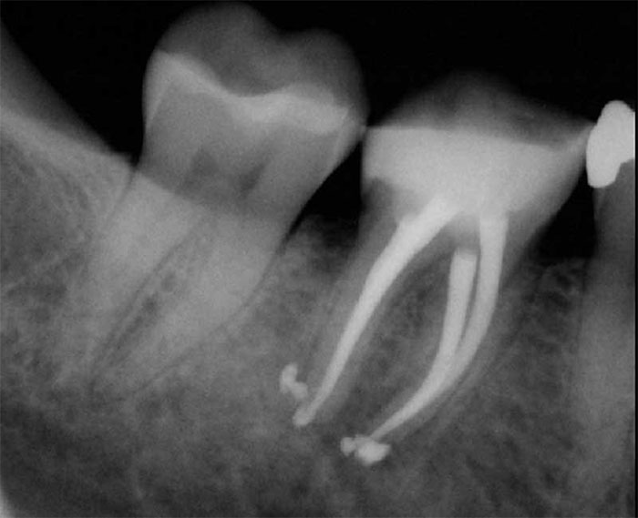 چه زمانی درمان کانال و ریشه دندان باید انجام شود