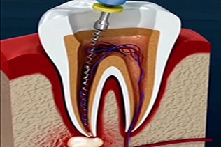 کانال دندان در عصب کشی