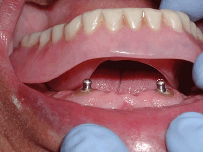 دندان مصنوعی غیر ثابت (متحرک) بر پایه ایمپلنت