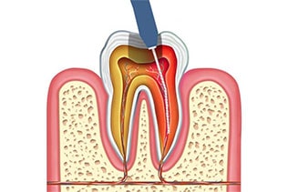 پالپکتومی دندان چیست