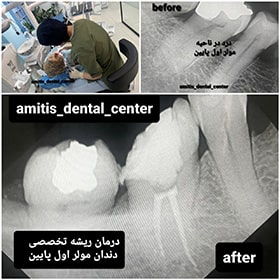 درمان ریشه تخصصی دندان مولر اول پایین