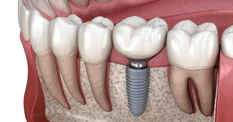 https://clinicgholhak.com/ ایمپلنت دندان